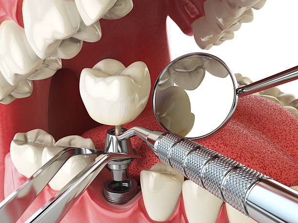 Best Emergency Root Canal Treatment in Algona, WA